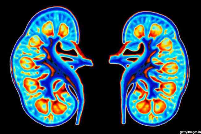 Kidney Diseases are Silent Killers!